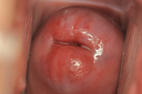 MRCP Part 1- Cervical ectropion
