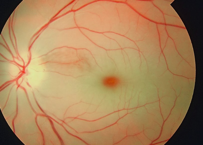MRCP Part 1 - Central retinal artery occlusion demonstrating a cherry-red spot at the fovea with surrounding retinal pallor
