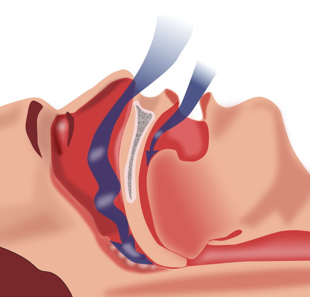MRCP Part 1 – airway collapse during sleep