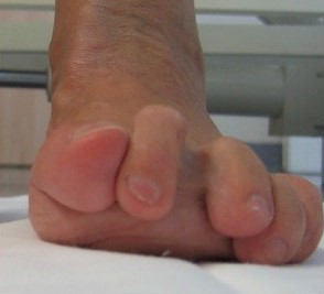 MRCP Part 1 – Claw toe deformities