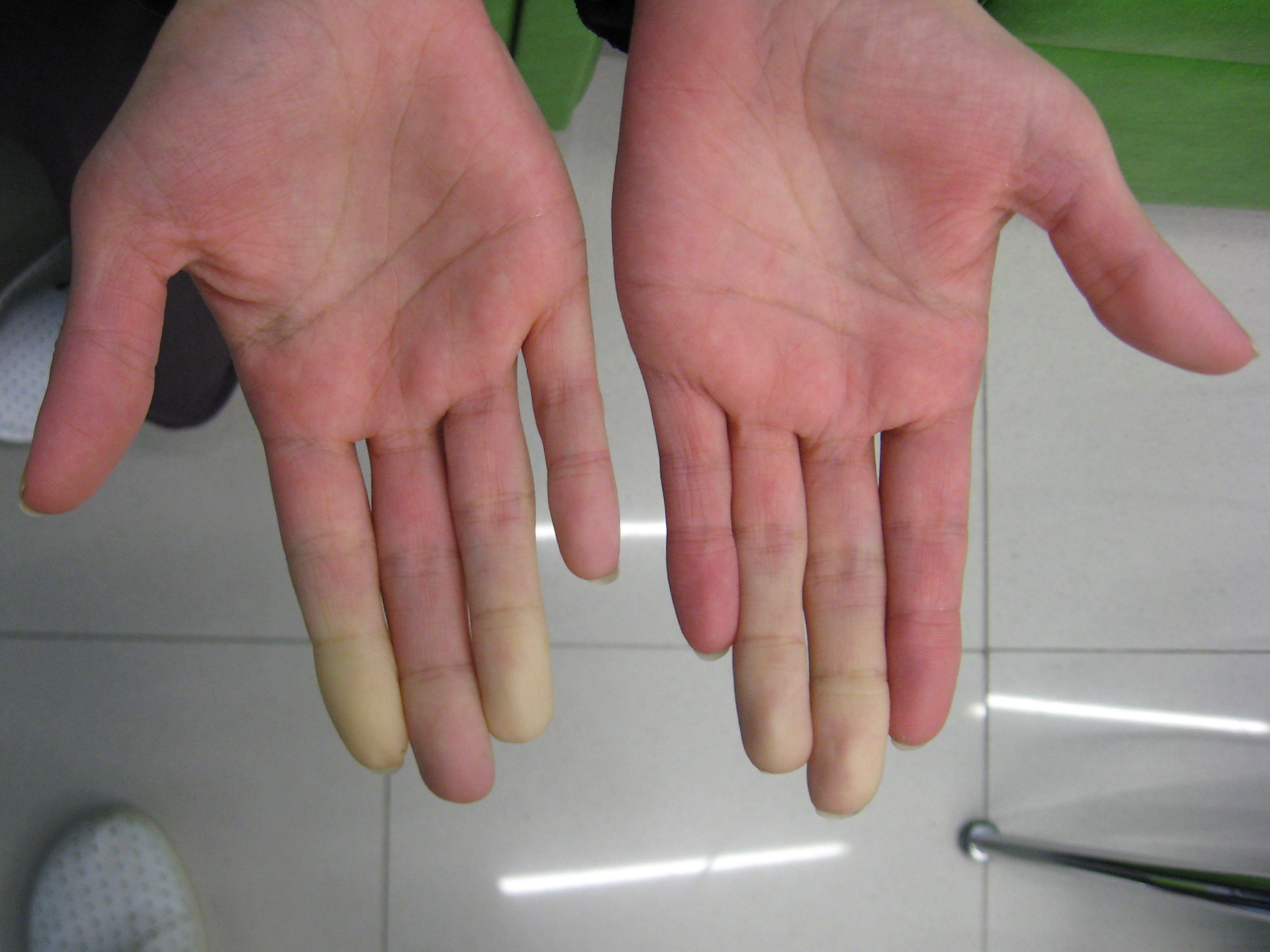 MRCP Part 1 – Raynaud's Phenomenon