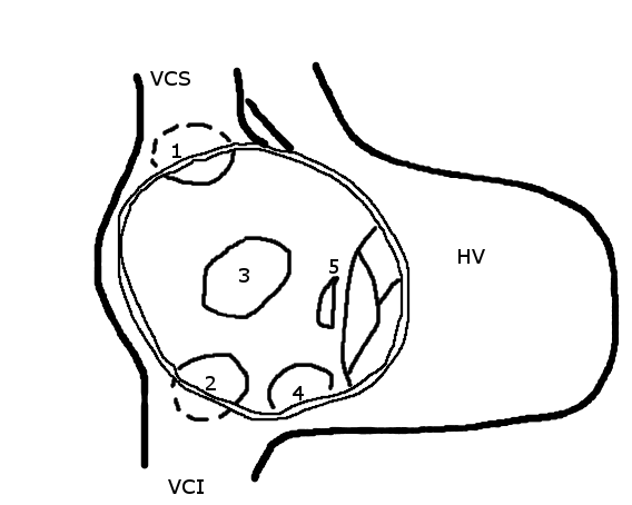 MRCP Part 1 - Schematic_drawing_of_various_types_of_atrial_septal_defect