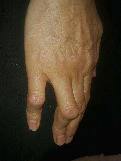 Boutonnière_deformity