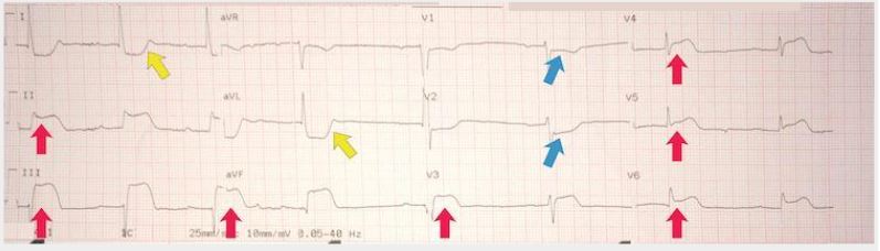 Inferoposterolateral STEMI