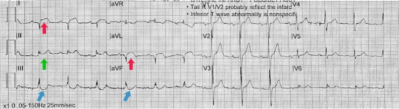 High lateral STEMI