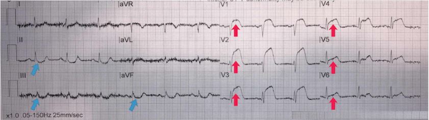 Anterior STEMI
