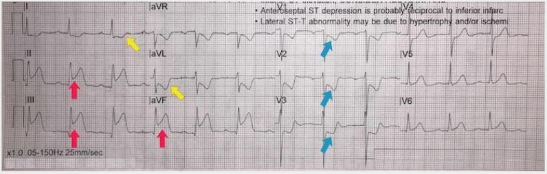 Inferoposterior STEMI