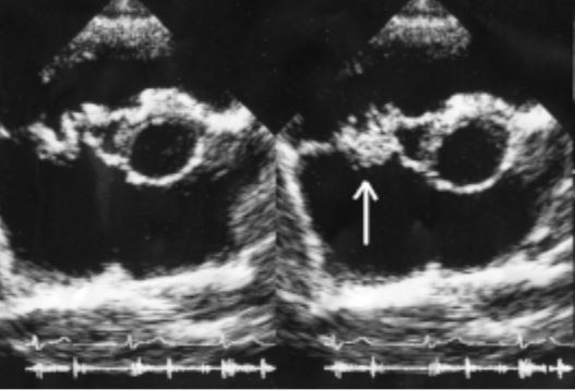 Infective Endocarditis