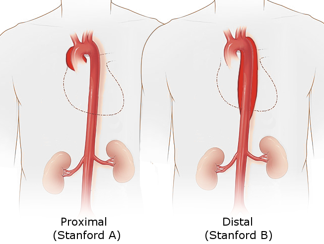 Aortic dissection types