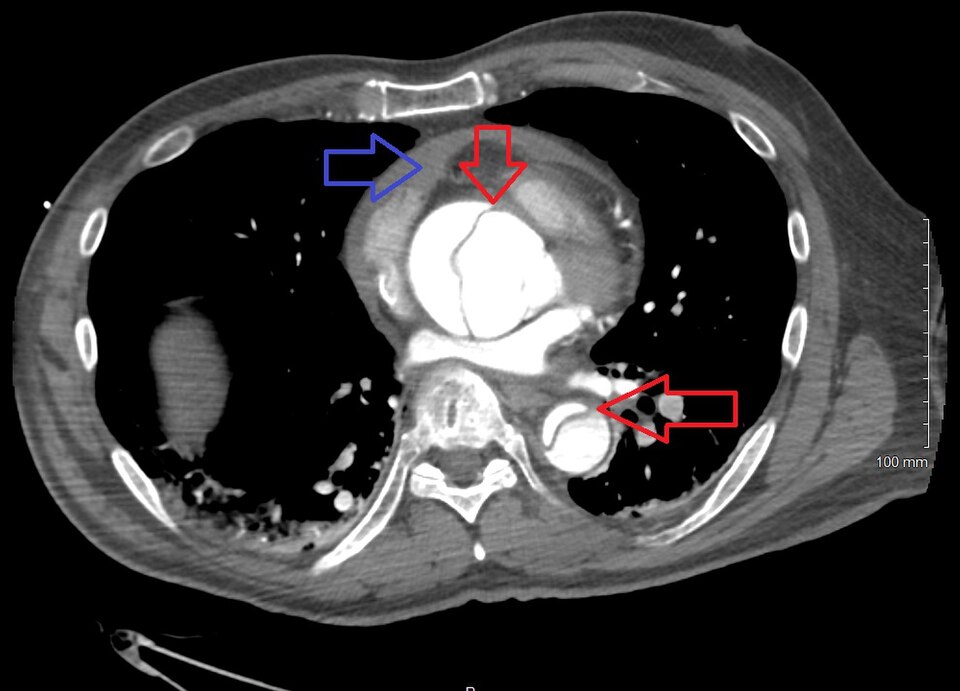 DissectionWithPericardial