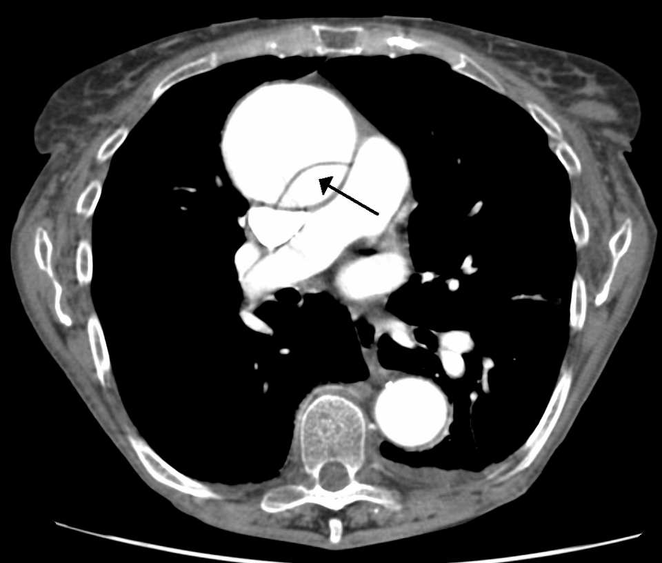 DissectionCT