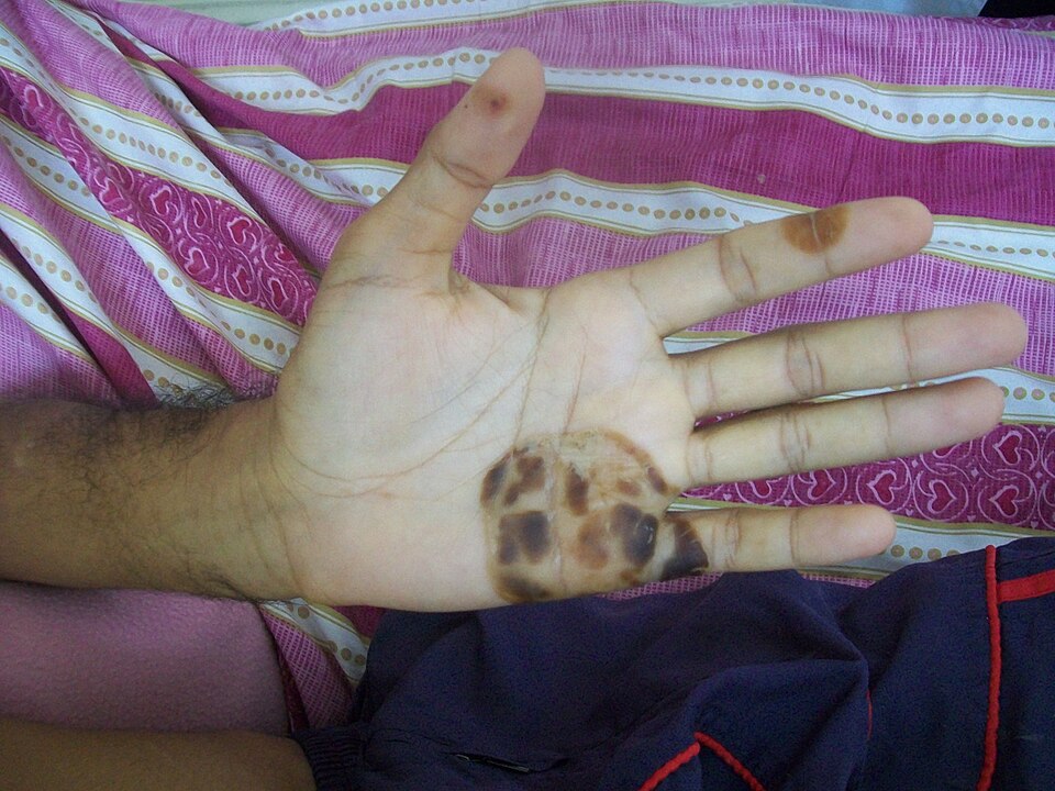 Osler Nodules Hand