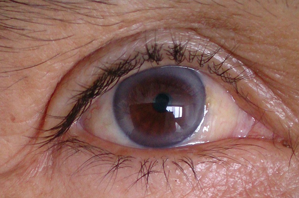 Corneal arcus