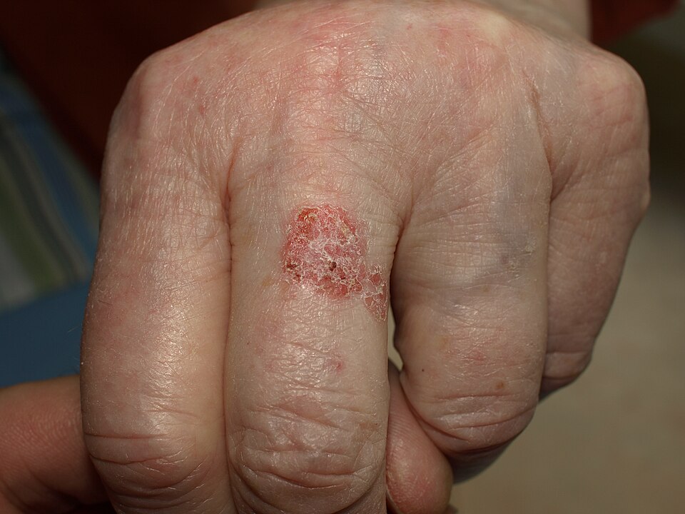 Bowen’s disease (cutaneous SCC in situ) 