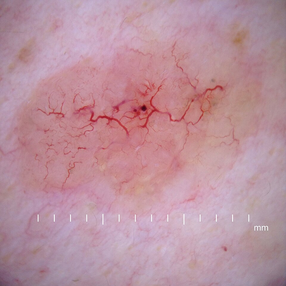 Dermoscopy of BCC 