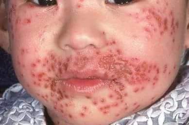Child with facial eczema herpeticum