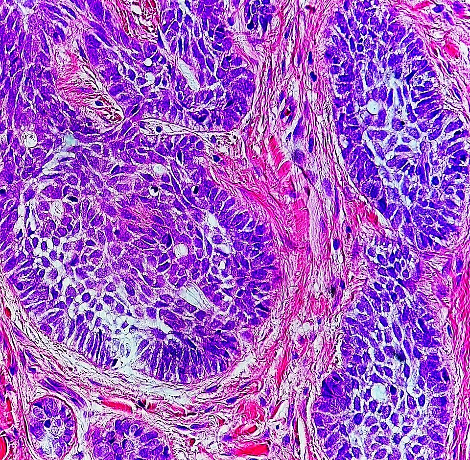 High-magnification micrograph of basal-cell carcinoma