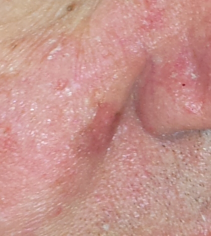 Irregular patch