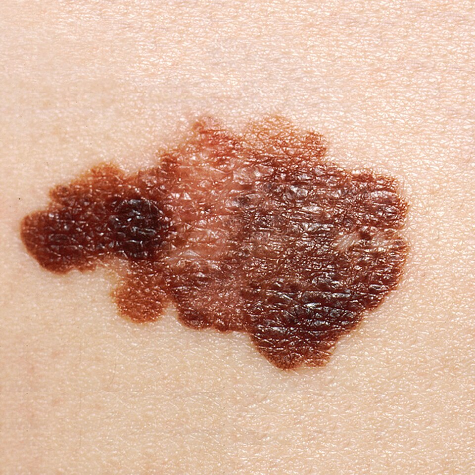 Superficial spreading melanoma