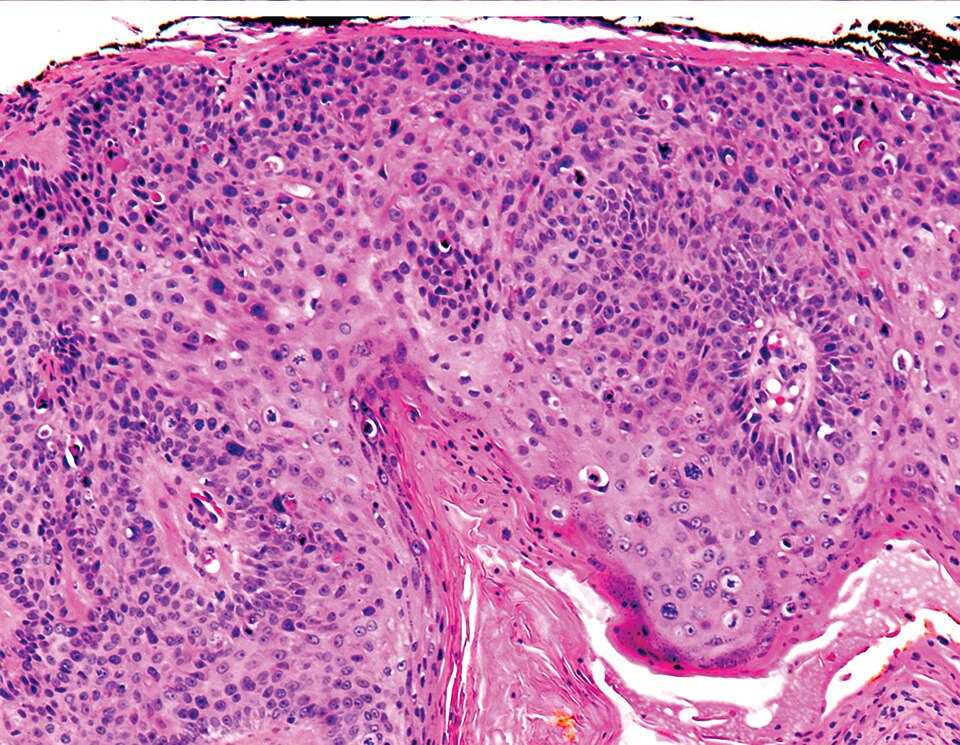 Histology of SCC 