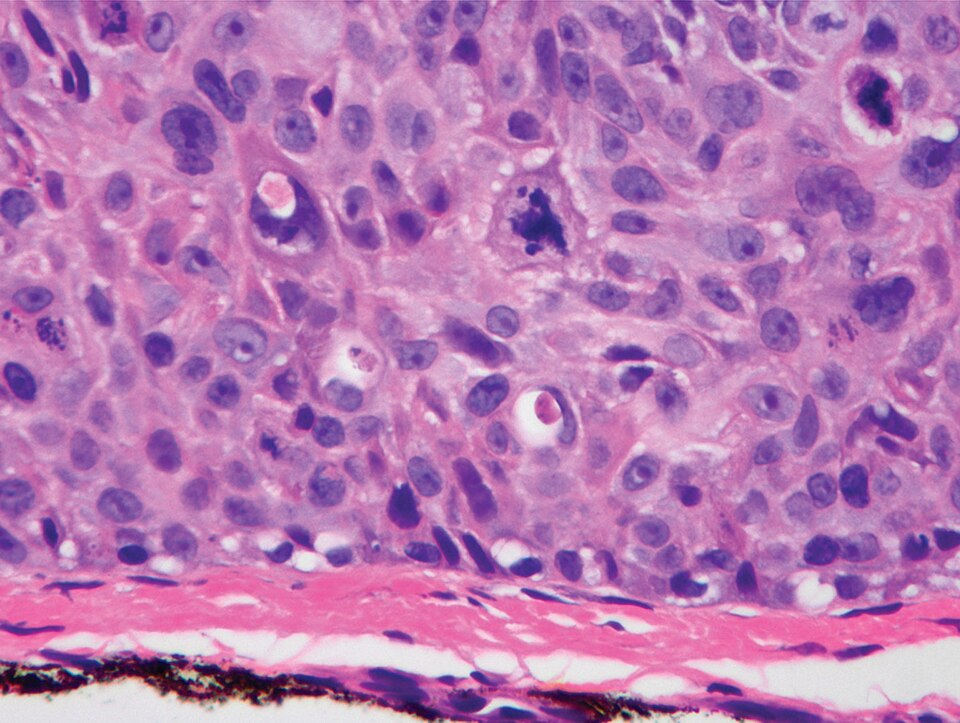 Micrograph of squamous cell carcinoma