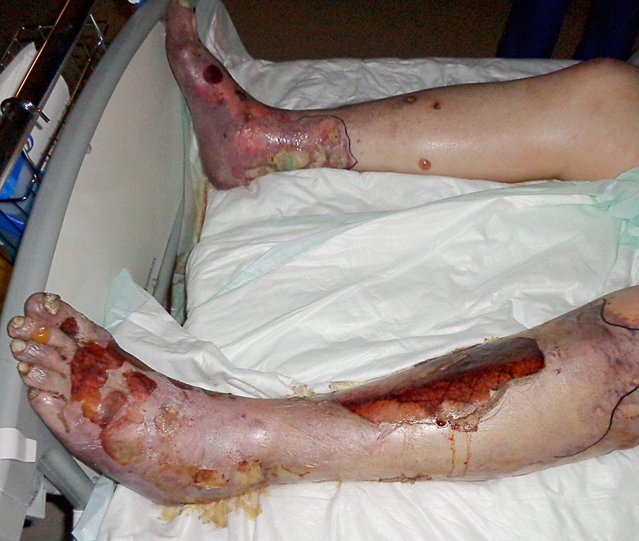 Necrolysis epidermalis toxica