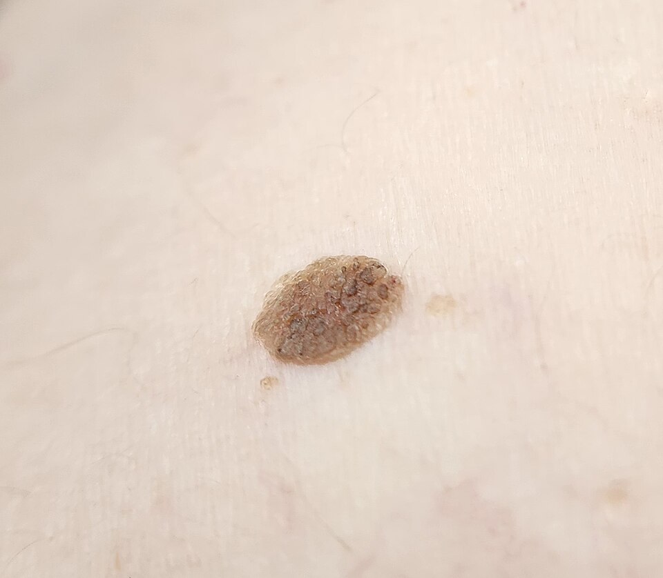Seborrheic keratosis