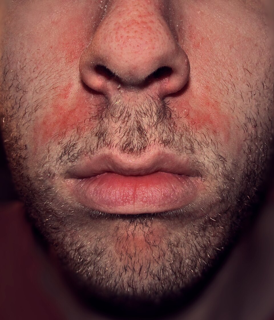 Seborrhoeic_dermatitis_highres