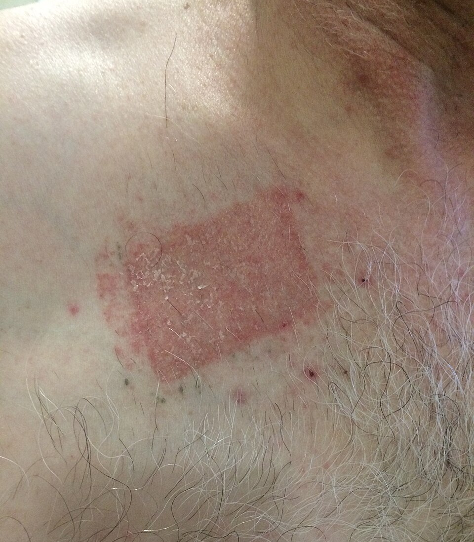 Severe_contact_dermatitis_buprenorphine_transdermal_patch